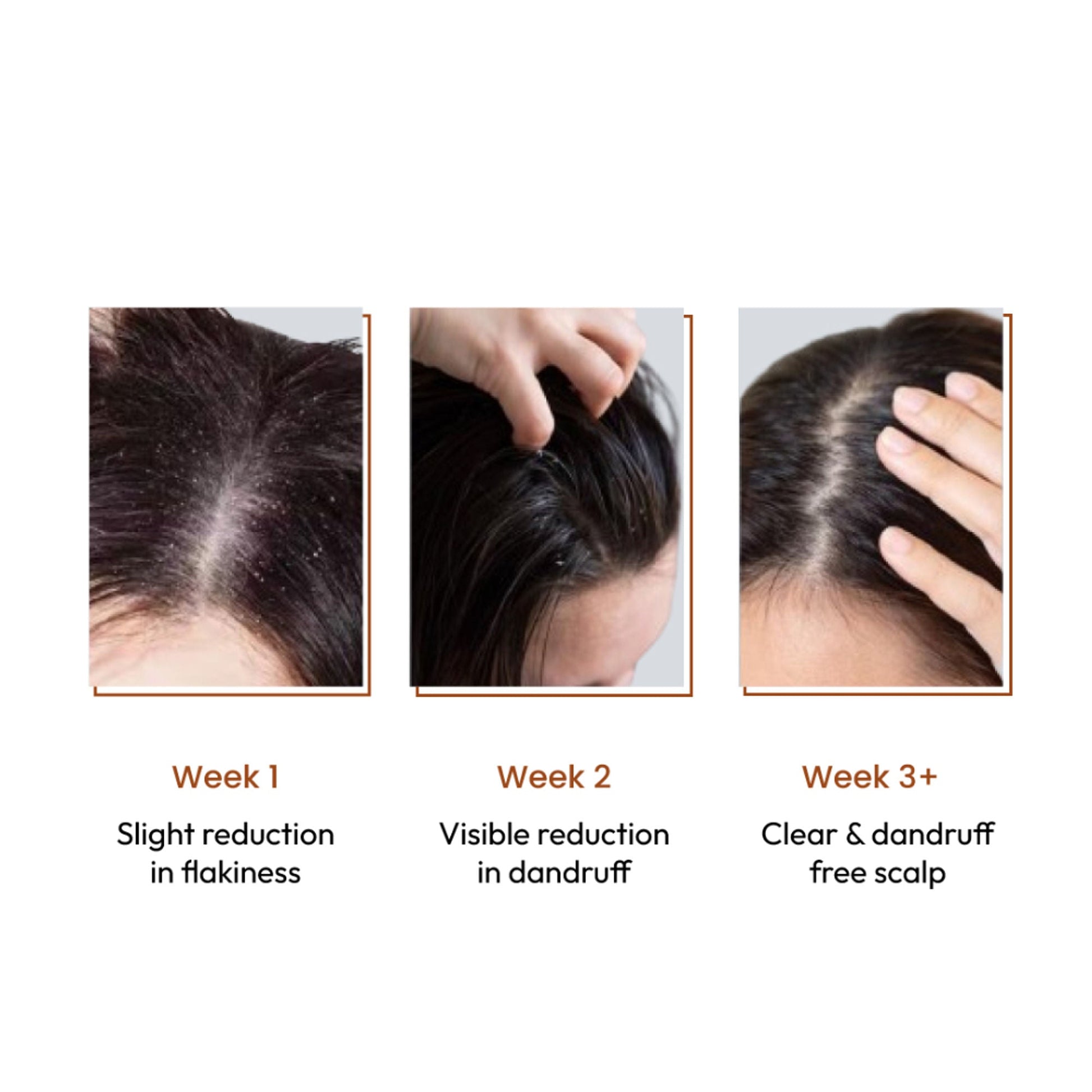 SANCTUS 4% Dandelix Pro Anti-Dandruff Hair Serum For Scalp