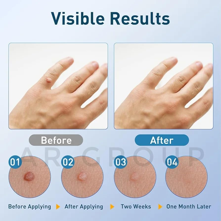 Wart & Skin Tag Remover Ointment 100g