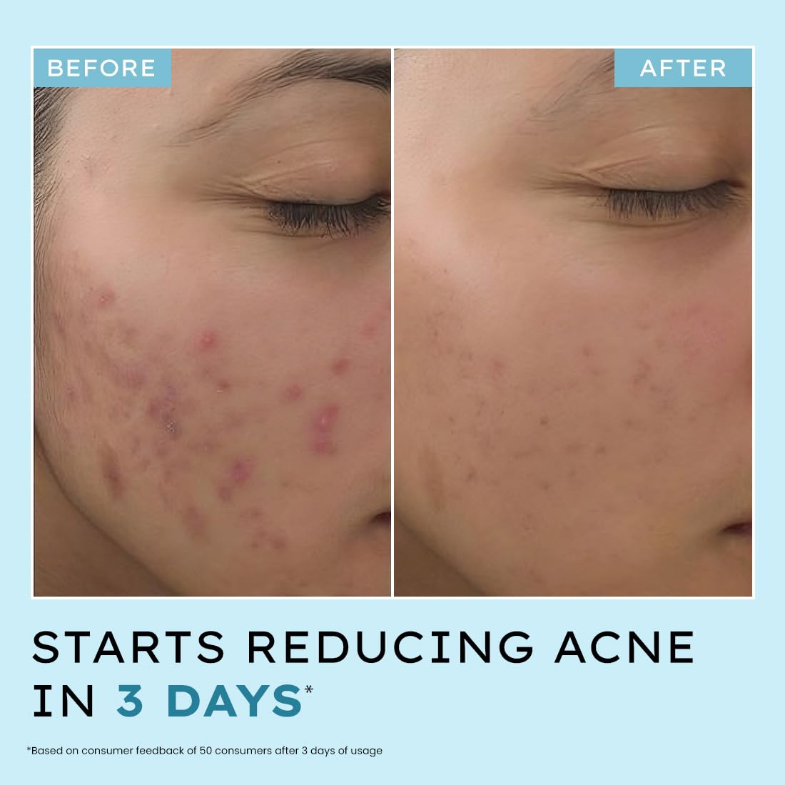 Hyphen Anti Acne 10% Azelaic Acid 2% Salicylic Acid Face Serum | 4% Niacinamide -Reduce Acne Marks, Fight Pimples | Tea Tree Extract -Soothes | Daily Serum for Women, Men | Oily, Acne Prone Skin -30ml