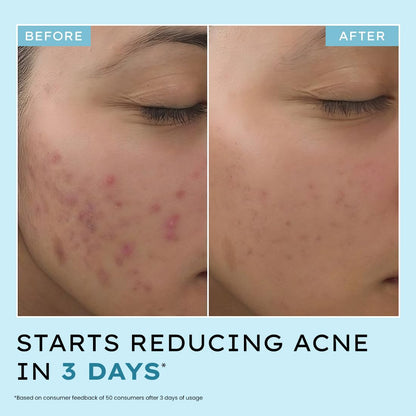 Hyphen Anti Acne 10% Azelaic Acid 2% Salicylic Acid Face Serum | 4% Niacinamide -Reduce Acne Marks, Fight Pimples | Tea Tree Extract -Soothes | Daily Serum for Women, Men | Oily, Acne Prone Skin -30ml