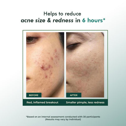 Rapid Relief Acne Spot Gel 15g - Clears Pimples & Reduces Redness
