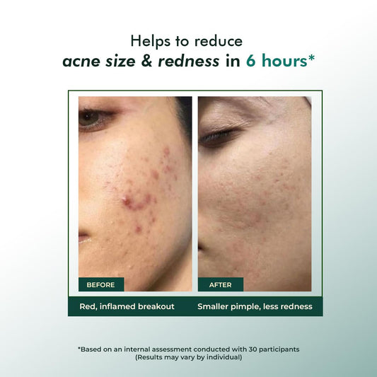 Rapid Relief Acne Spot Gel 15g - Clears Pimples & Reduces Redness