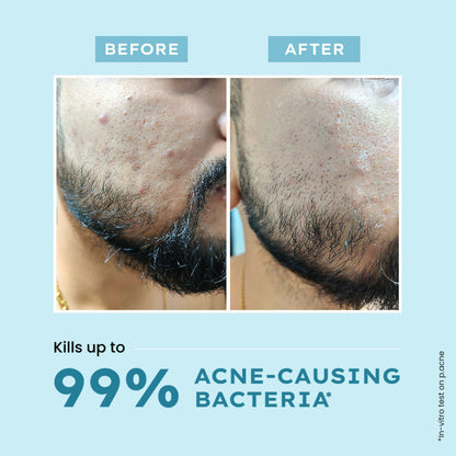 Hyphen By Kriti Sanon Acne Defence Daily Serum With 2% Salicylic Acid For Active Acne & Breakouts