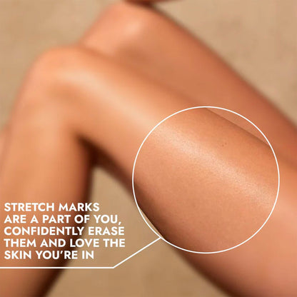 Cos-IQ Stretch Marks Removal Roll-On Serum with Striover