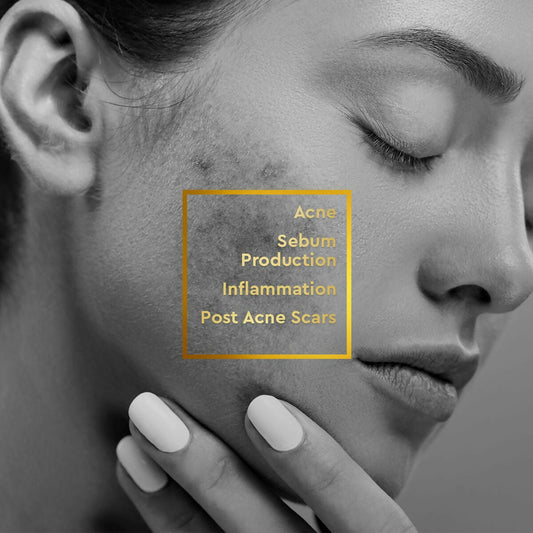 VLCC Clinic Acne Control Regime CSMS (Cleanser, Serum, Moisturizer, Sunscreen) For Acne Care Combo